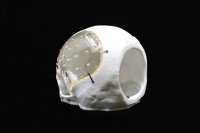 Acrylic Cranial Implant image 3