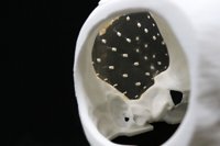 Acrylic Cranial Implant image 4