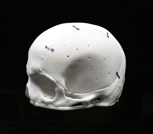 Acrylic Cranial Implant image 2