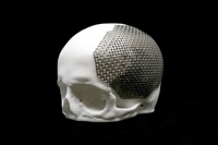 Titanium Cranial Implant image 1
