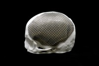 Titanium Cranial Implant image 2