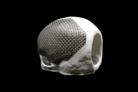Titanium Cranial Implant image 3