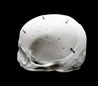 Acrylic Cranial Implant image 3