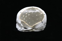 Acrylic Cranial Implant image 1