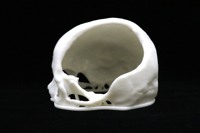 Acrylic Cranial Implant image 2