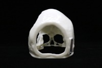 Acrylic Cranial Implant image 2