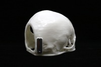 Acrylic Cranial Implant image 1