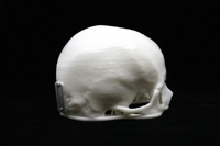 Acrylic Cranial Implant image 2