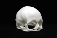 Acrylic Cranial Implant image 1