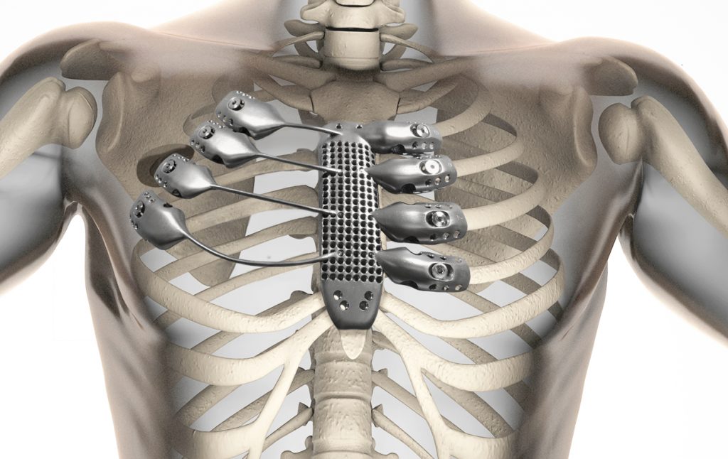 First 3d printer sternum