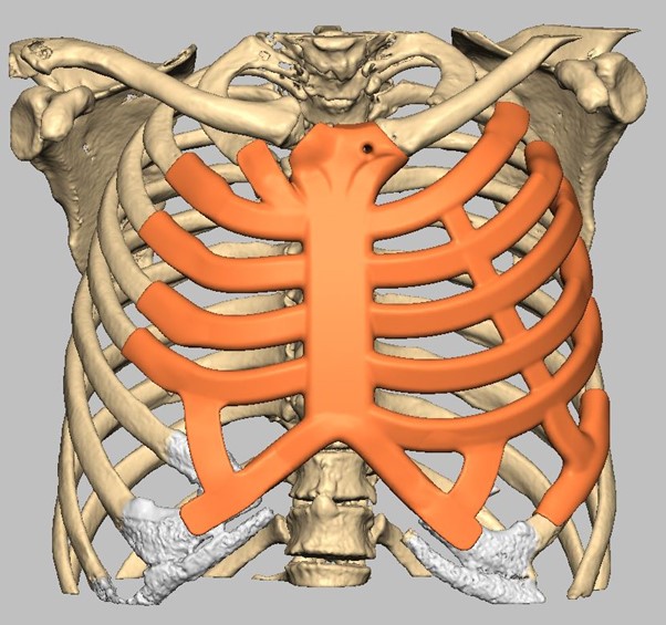 3D model for the design of a StarPore Thoracic Implant