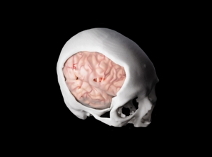 Acrylic Cranial Implant image 2