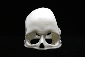 Acrylic Cranial Implant image 2